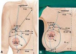 Nâng ngực một thời gian, bị vỡ túi ngực mà không hề hay biết